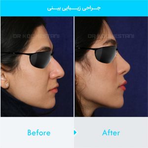 rhinoplasty-223