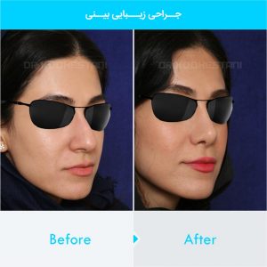 rhinoplasty-224