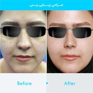 rhinoplasty-225