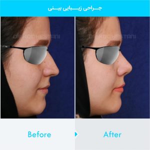 rhinoplasty-226