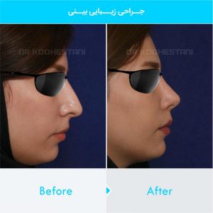 rhinoplasty-228