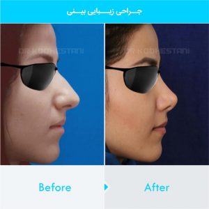 rhinoplasty-231