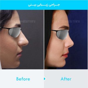 rhinoplasty-234