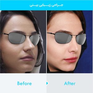 rhinoplasty-235