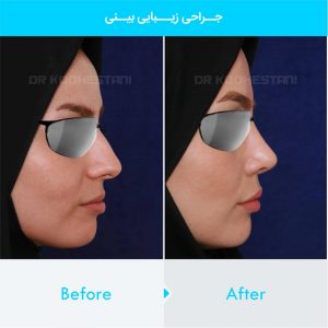 rhinoplasty-237