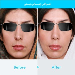 rhinoplasty-239