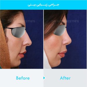 rhinoplasty-240