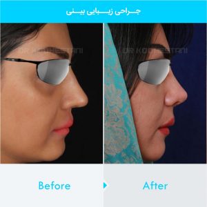 rhinoplasty-243