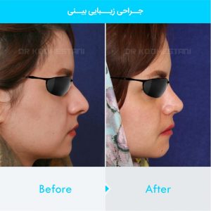 rhinoplasty-245