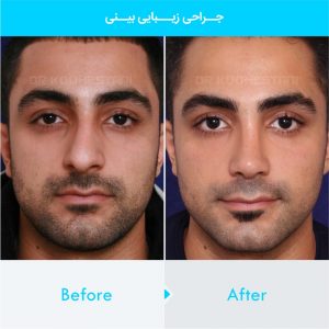 rhinoplasty-247