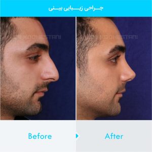 rhinoplasty-248