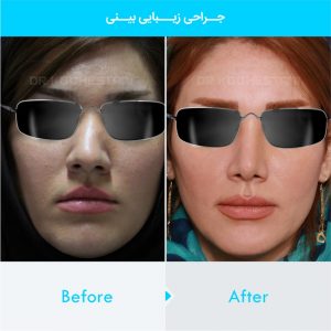 rhinoplasty-250