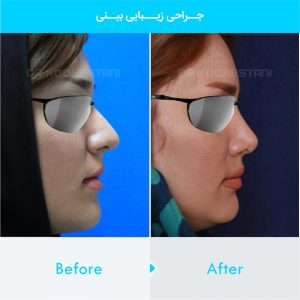 rhinoplasty-251