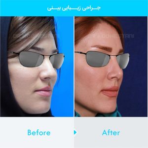 rhinoplasty-252