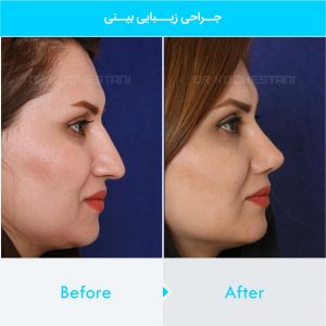 rhinoplasty-254