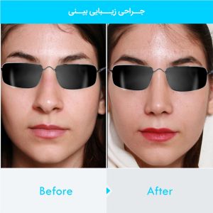 rhinoplasty-255