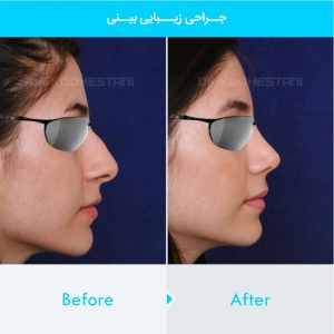 rhinoplasty-256