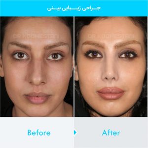 rhinoplasty-257