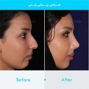 rhinoplasty-258