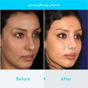 rhinoplasty-259