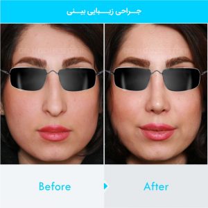 rhinoplasty-260