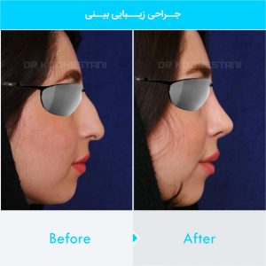 rhinoplasty-261