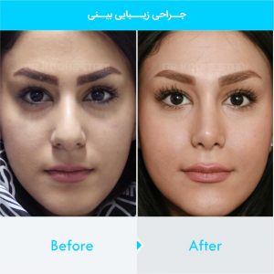 rhinoplasty-263