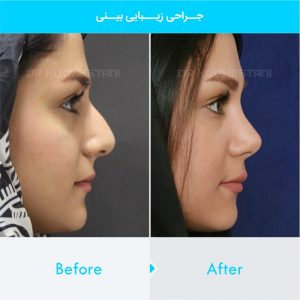 rhinoplasty-264