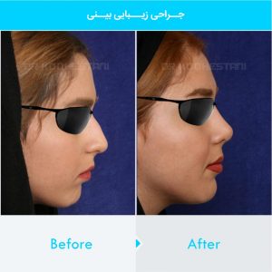 rhinoplasty-267