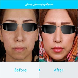 rhinoplasty-269