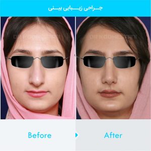 rhinoplasty-271