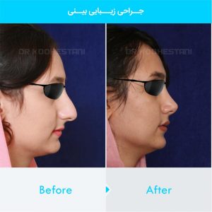 rhinoplasty-272