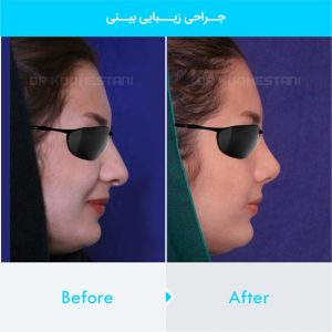 rhinoplasty-274