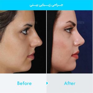 rhinoplasty-277