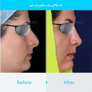 rhinoplasty-279