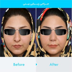 rhinoplasty-280