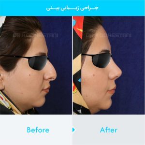 rhinoplasty-281