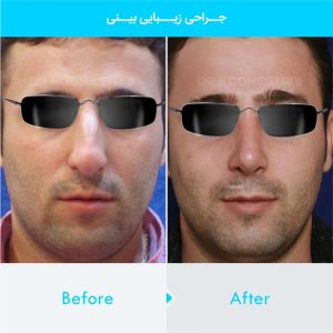 rhinoplasty-283