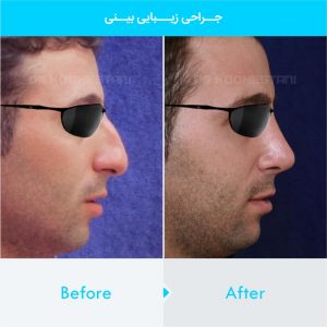 rhinoplasty-284