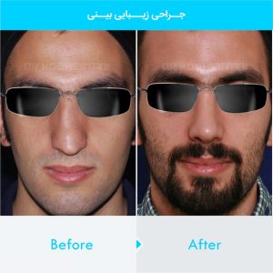 rhinoplasty-285