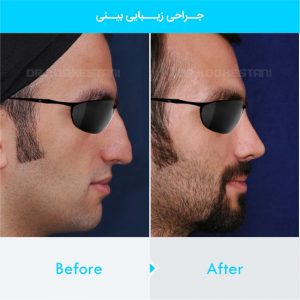 rhinoplasty-286