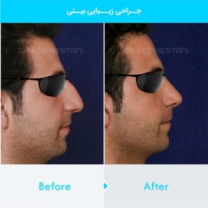 rhinoplasty-289
