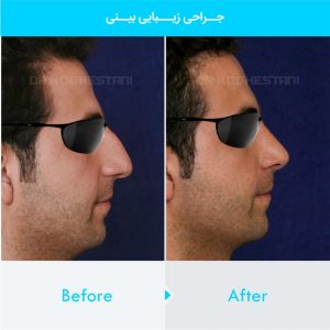 rhinoplasty-289