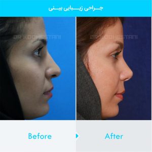 rhinoplasty-291