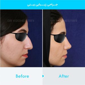 rhinoplasty-293