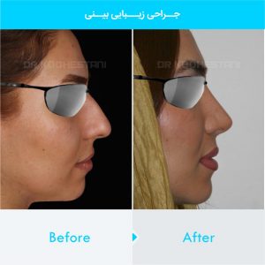 rhinoplasty-295