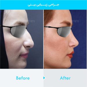 rhinoplasty-296