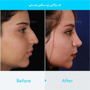 rhinoplasty-298