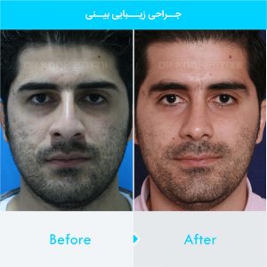 rhinoplasty-300