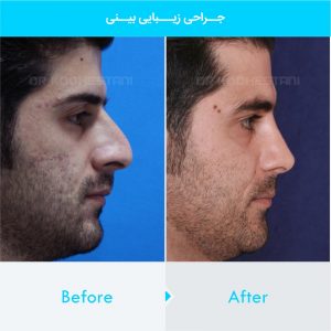 rhinoplasty-301